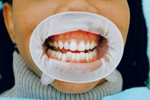 Fehlstellung der Zähne