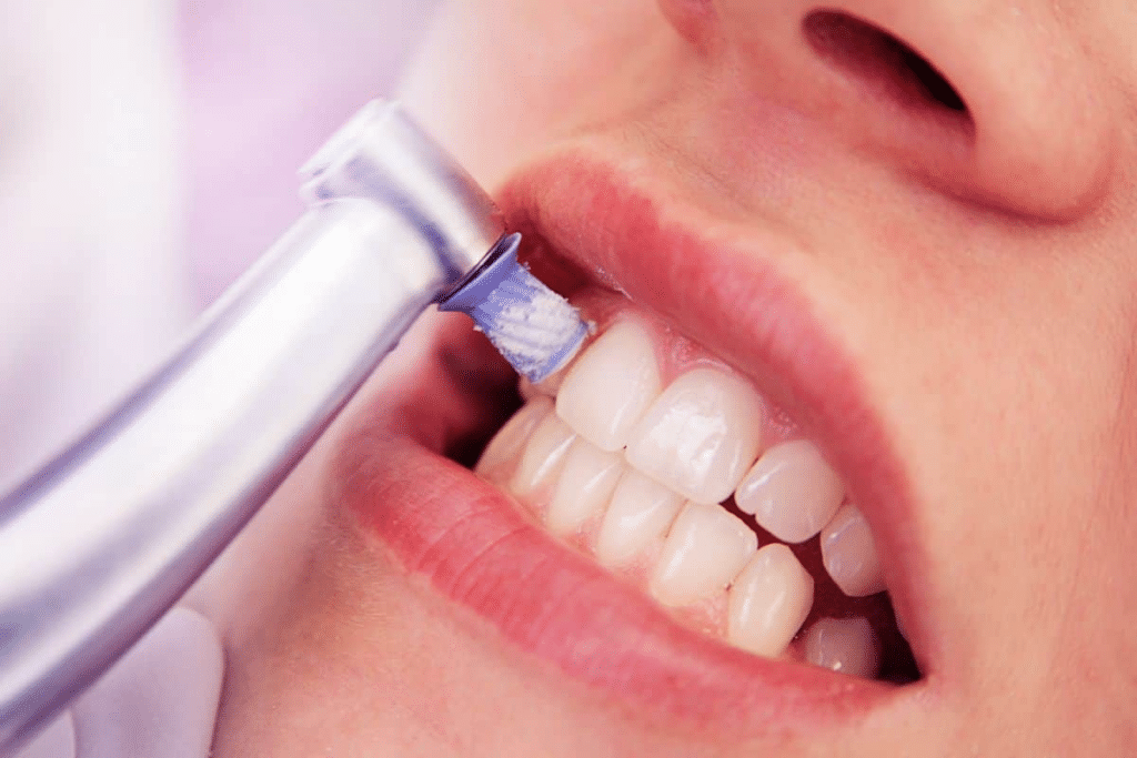 Fluorose - Weiße Flecken auf den Zähnen? 1