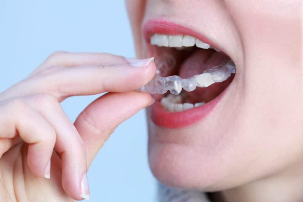 Knirschschiene: Deine Zähne vor nächtlichem Abrieb schützen 3